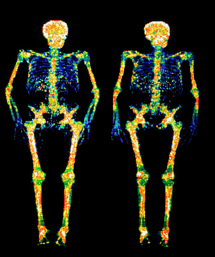 Bone Densitometry Scans Of The Skeletons Of Twins Photograph by Dr. Nigel Morrison/science Photo Library