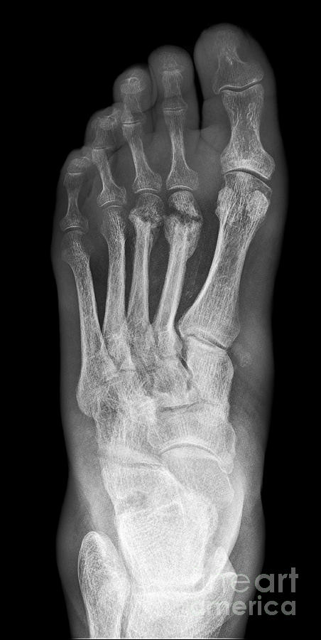 Osteomyelitis X Ray