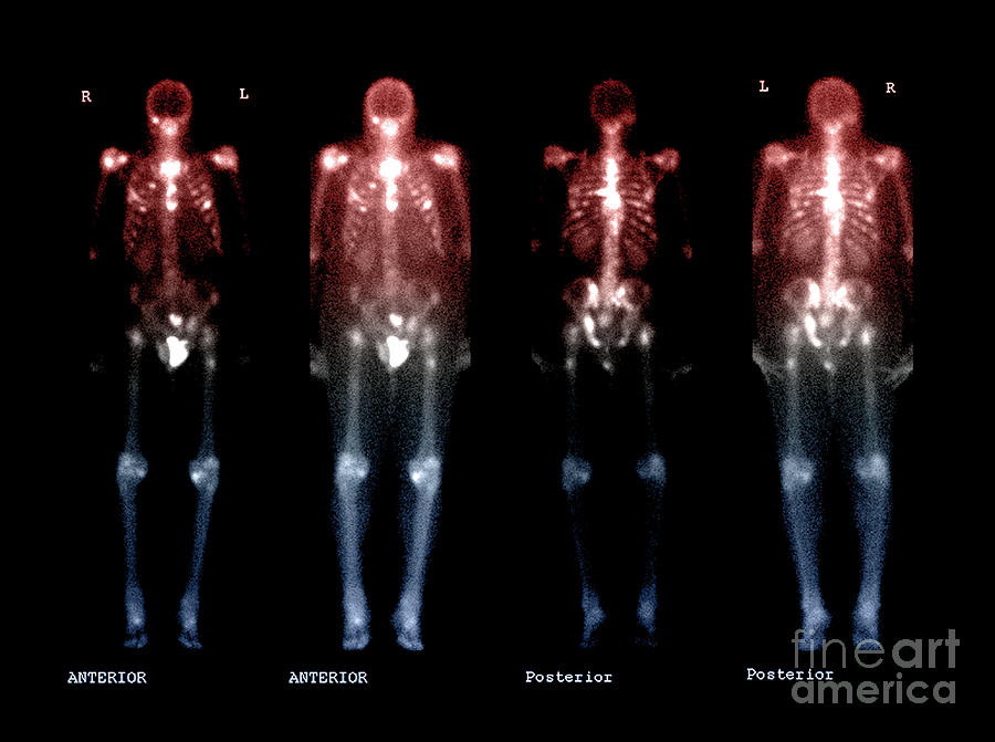 Bone Scan Of Metastatic Disease Photograph by Living Art Enterprises ...