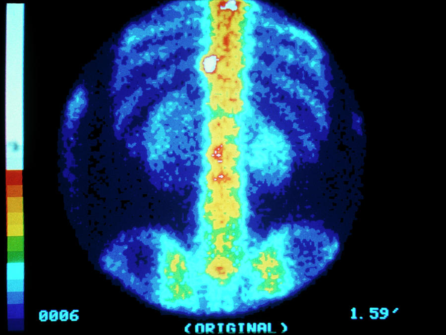 Bone Scintigram Of Person Suffering From Cancer Photograph by Cnri ...