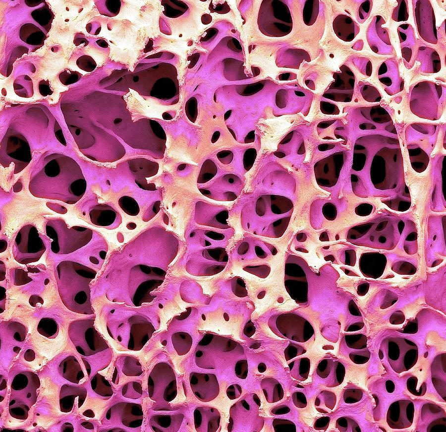 Bone Tissue Photograph by Steve Gschmeissner/science Photo Library