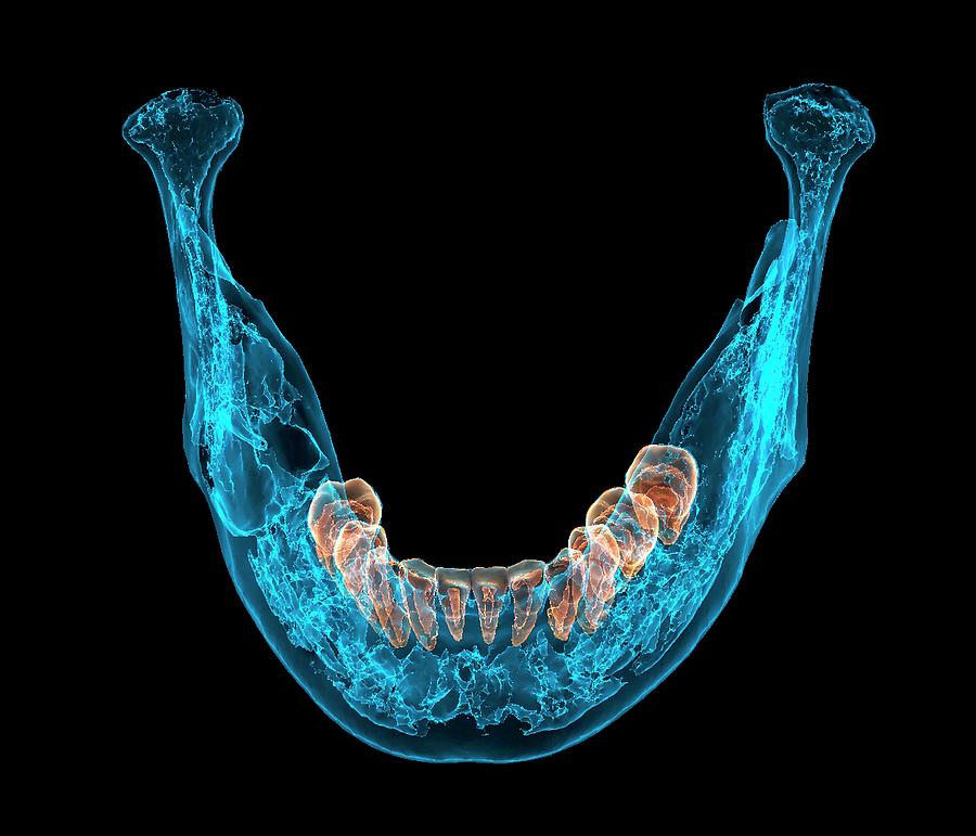 Bone Tumour Photograph by K H Fung/science Photo Library