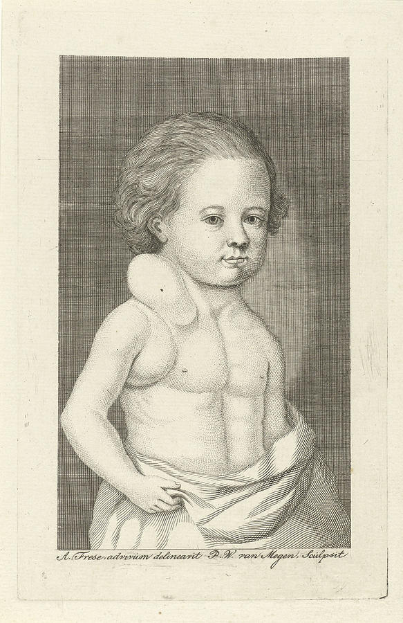 Boy With A Tumor, Pieter Willem Van Megen Drawing by Quint Lox - Pixels