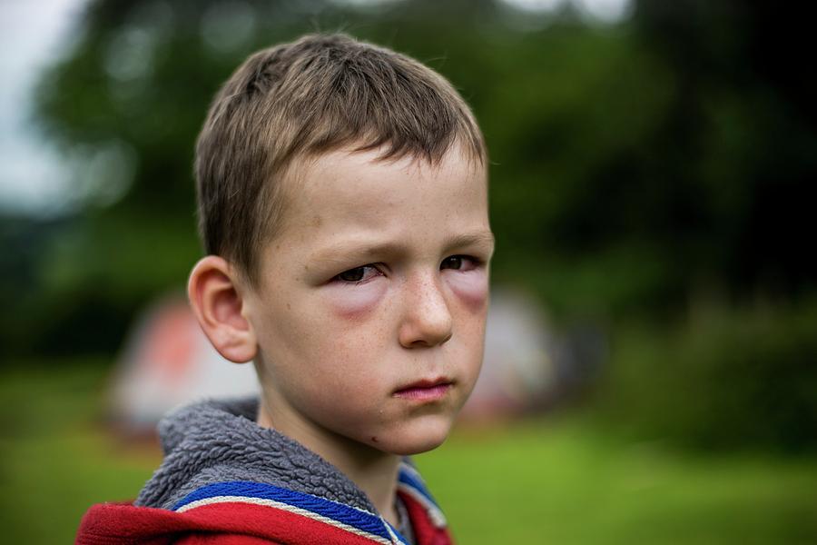 Boy With Hay Fever Allergic Reaction Photograph by Samuel Ashfield