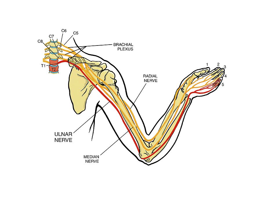 Brachial Plexus Arm Nerve Injury Photograph By John T Alesi My XXX   Brachial Plexus Arm Nerve Injury John T Alesi 