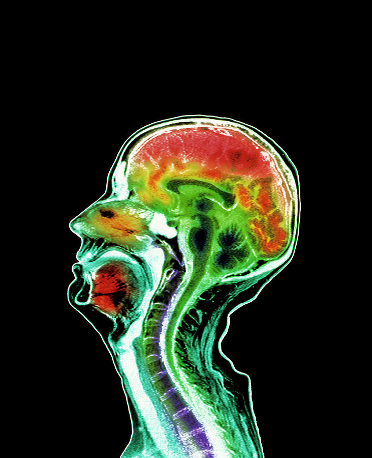 brain-atrophy-photograph-by-simon-fraser-royal-victoria-infirmary