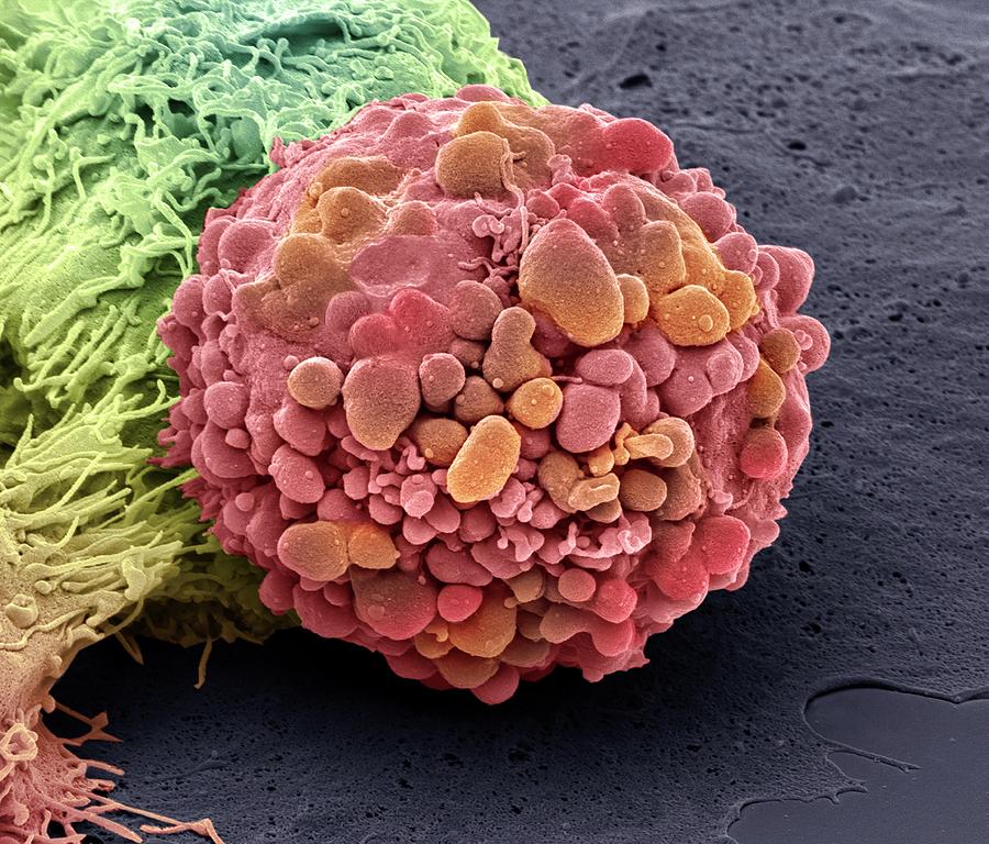 brain cancer cell