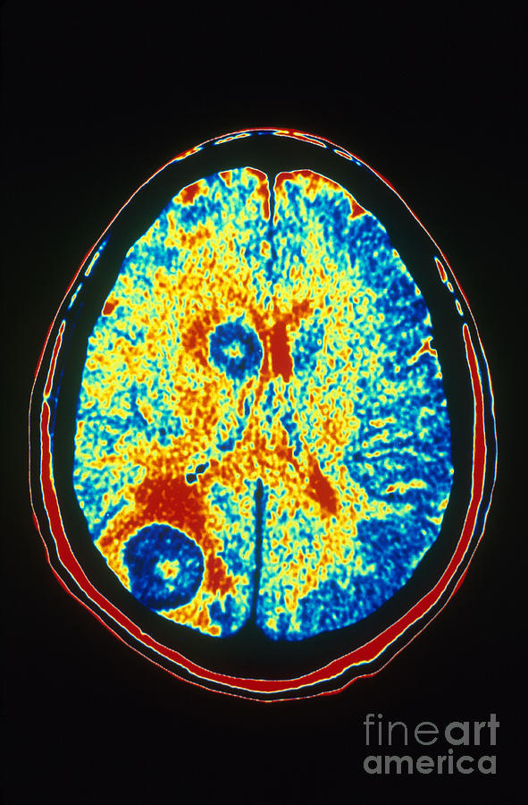 Brain Cancer, Ct Scan Photograph by Scott Camazine
