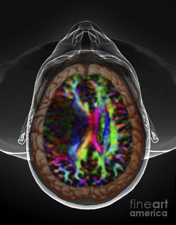 Brain Cancer Dti And 3d Ct Scans Photograph By Zephyr