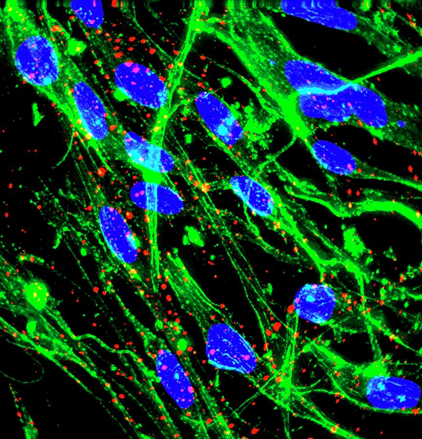 Brain Cancer Glial Cells Photograph by R. Bick, B. Poindexter, Ut Medical School/science Photo Library