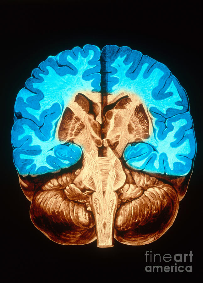 Brain, Coronal Section Photograph by Scott Camazine