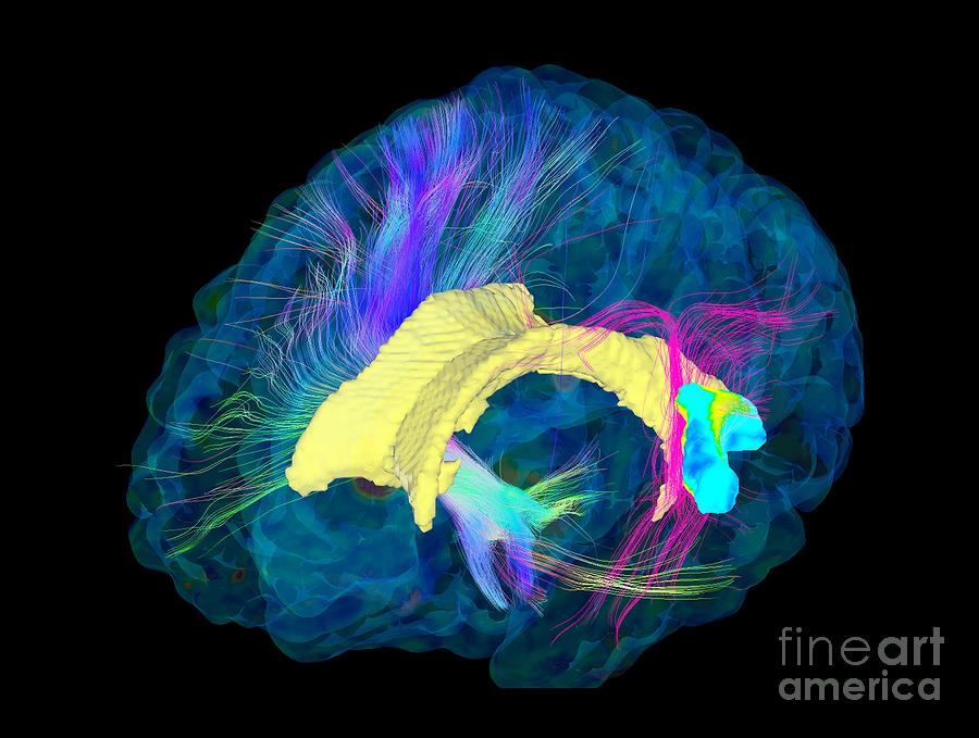 Neural Pathway Photograph - Brain Fibres, Dti Mri Scan by Sherbrooke Connectivity Imaging Lab