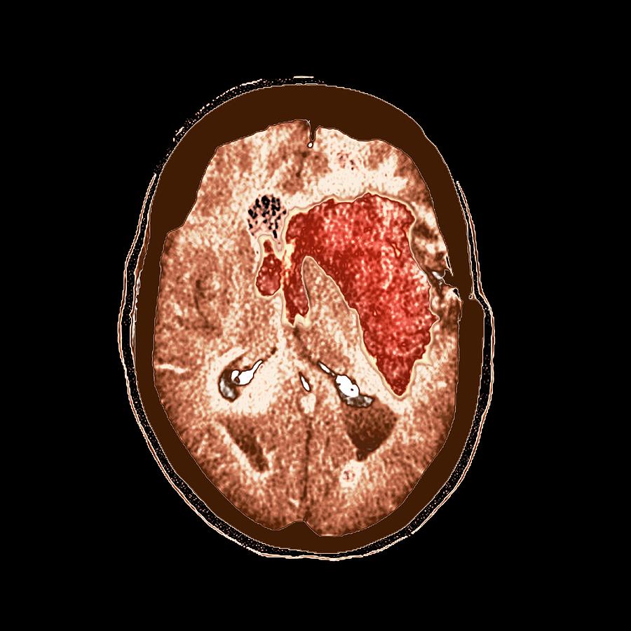 Brain Haemorrhage Photograph by Science Photo Library