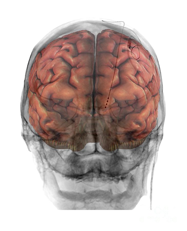 болезнь паркинсона операция на мозг