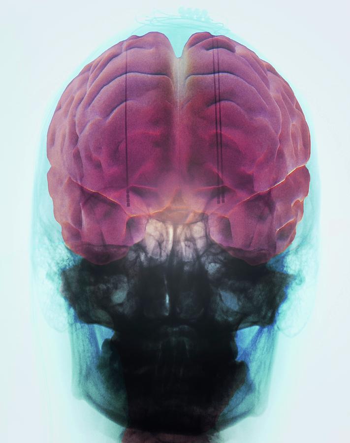 Brain Implants For Parkinsons Disease Photograph By Zephyrscience