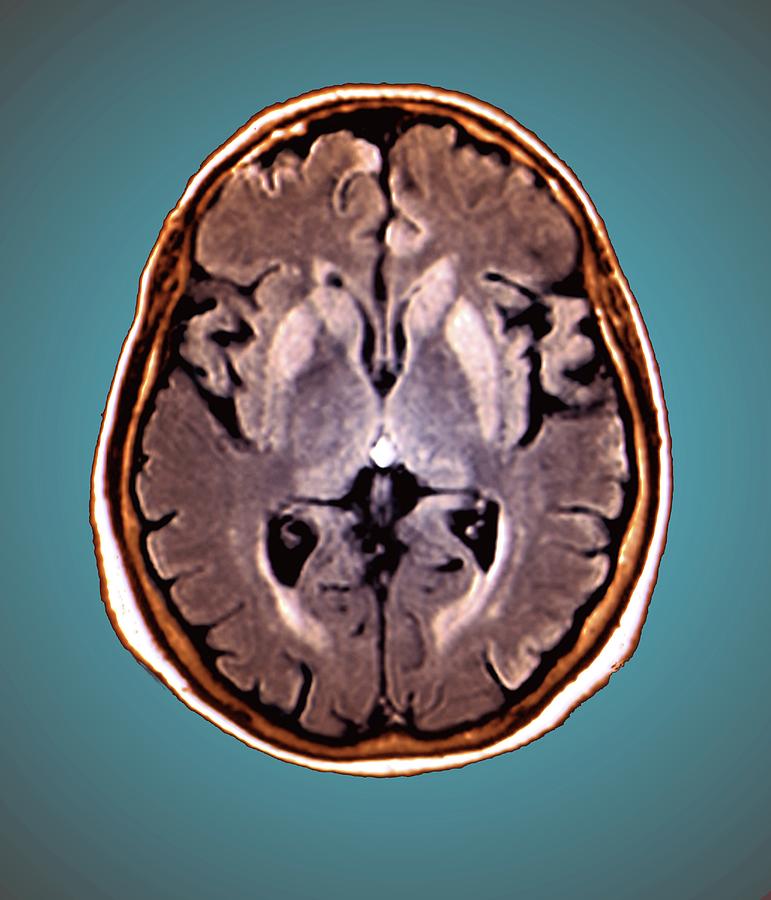 Brain In Creutzfeldt-jakob Disease Photograph by Zephyr