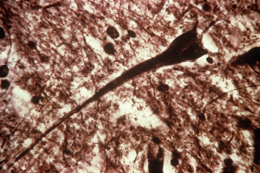 Light Micrograph Photograph - Brain In Dementia by Pr. S. Brion/cnri