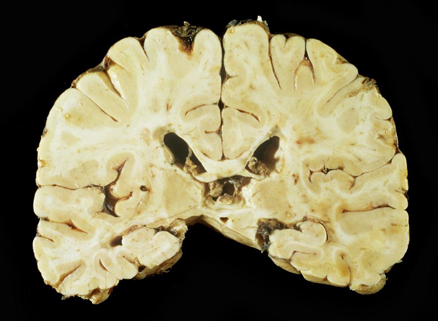 Brain In Multiple Sclerosis Photograph by Cnri/science Photo Library
