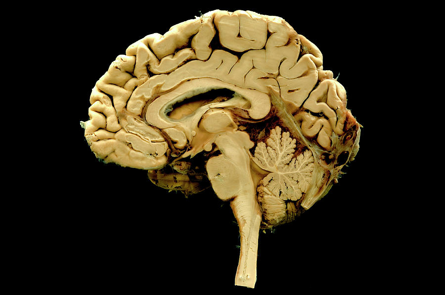 Brain Photograph by Medimage/science Photo Library