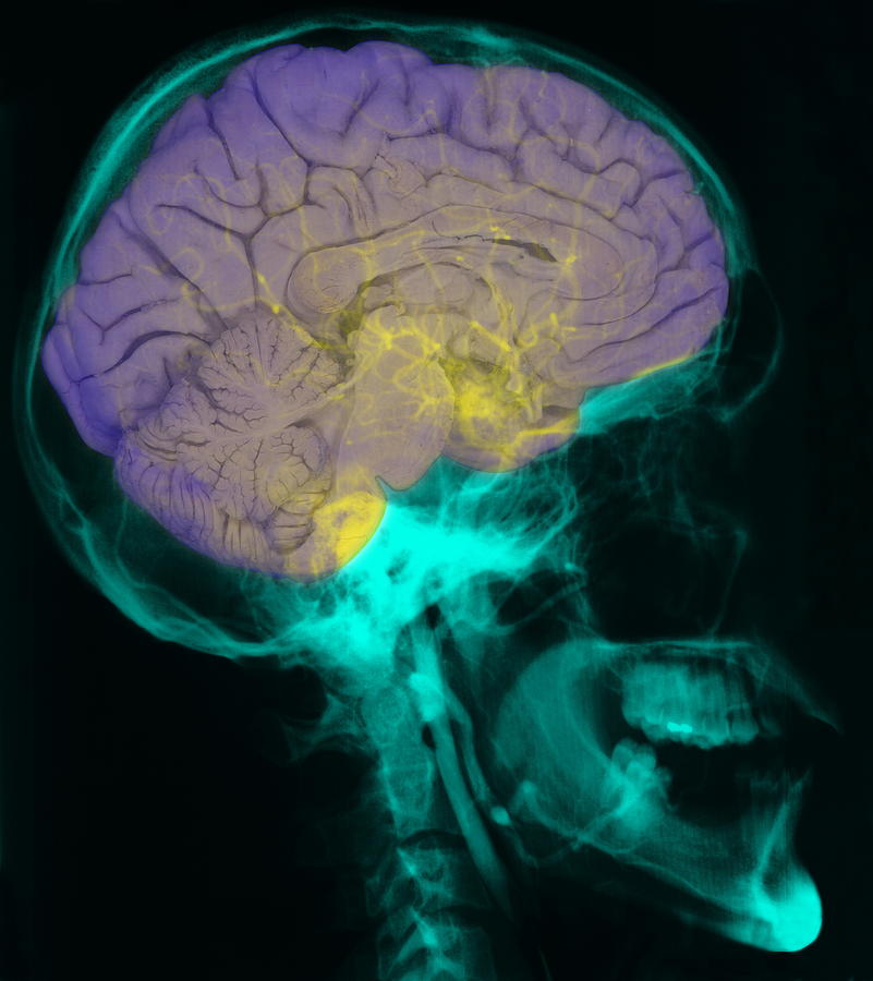 Brain On Skull X-ray Photograph by Tissuepix/science Photo Library