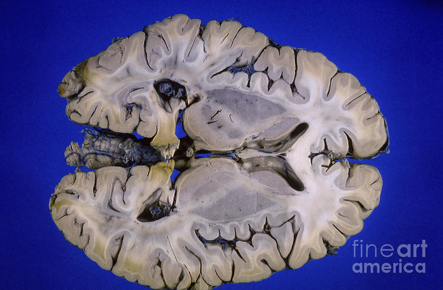 Science Photograph - Brain by Patrick J. Lynch