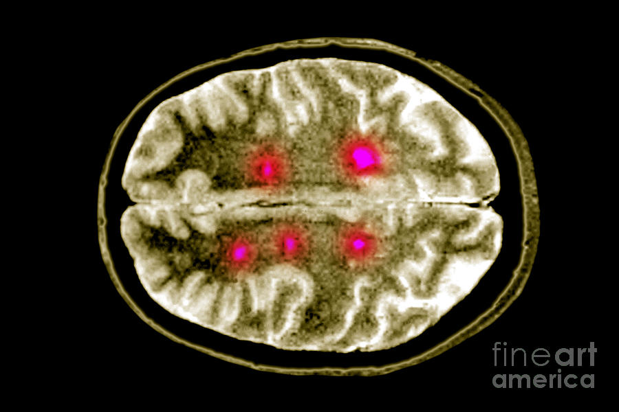 Brain Scan Of Ms Photograph By Scott Camazine Fine Art America