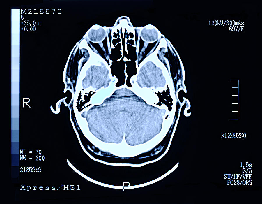Brain scan Photograph by Peter Dazeley