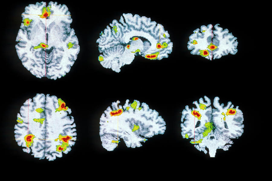 Obsessive Compulsive Disorder Photograph - Brain Scan by Wellcome Dept. Of Cognitive Neurology/ Science Photo Library