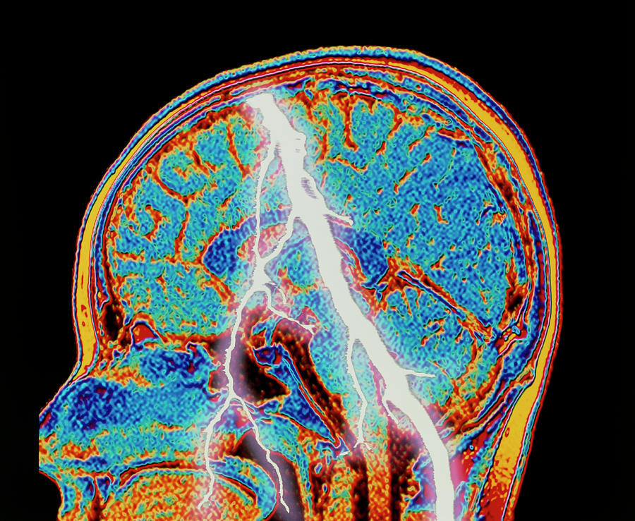 Brain Scan With Lightning: Headache Or Epilepsy Photograph by Alfred  Pasieka/science Photo Library - Pixels