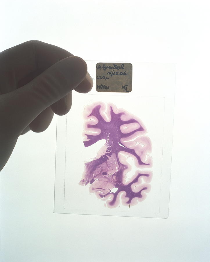 Brain Slice Photograph by Simon Fraser/newcastle General Hospital ...