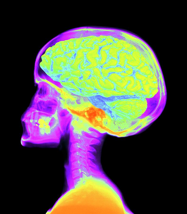Brain Superimposed On Colour X-ray Of Human Skull Photograph by Mehau Kulyk/science Photo Library