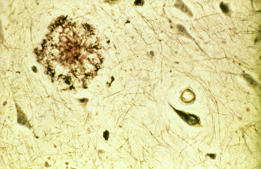 Alzheimer's Photograph - Brain Tissue With Alzheimers Disease by Dr. M. Goedert/science Photo Library