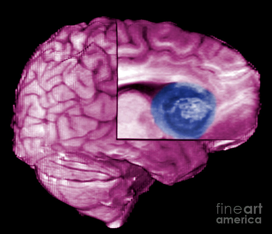 Brain Tumor, Mri Photograph by Living Art Enterprises