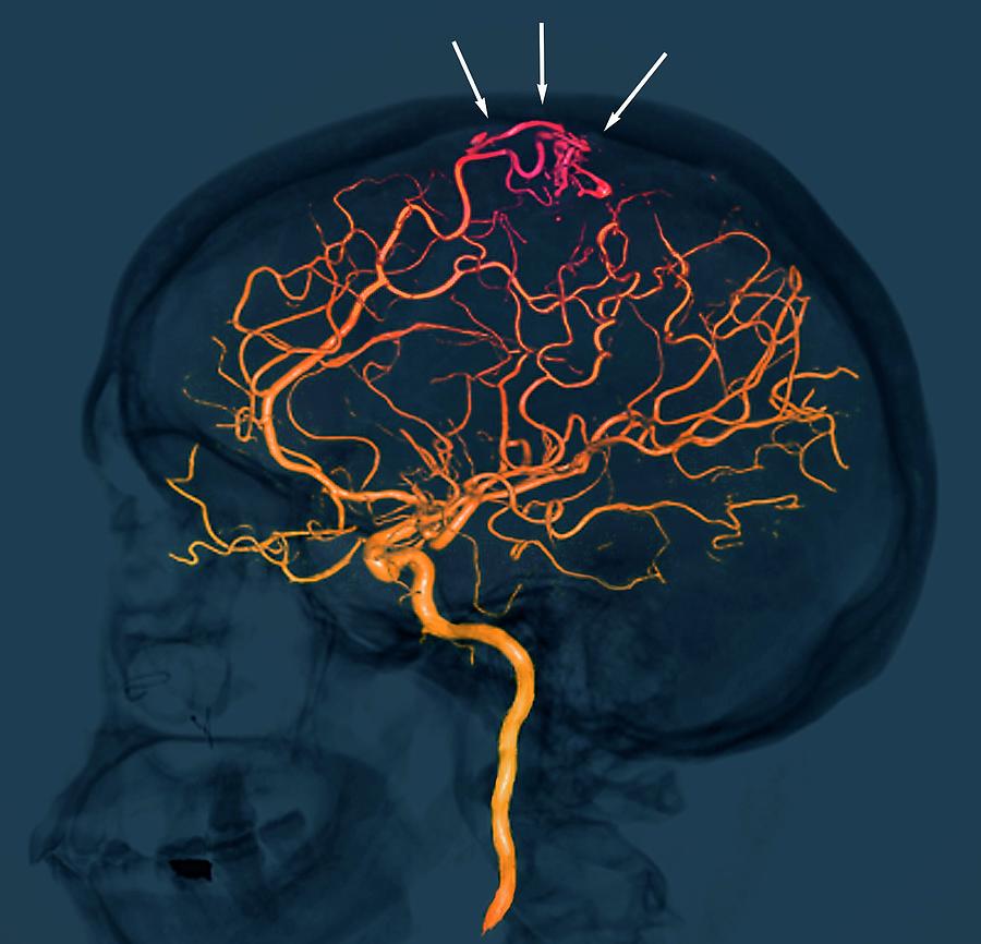 Brain Vascular Abnormality Photograph by Zephyr/science Photo Library ...