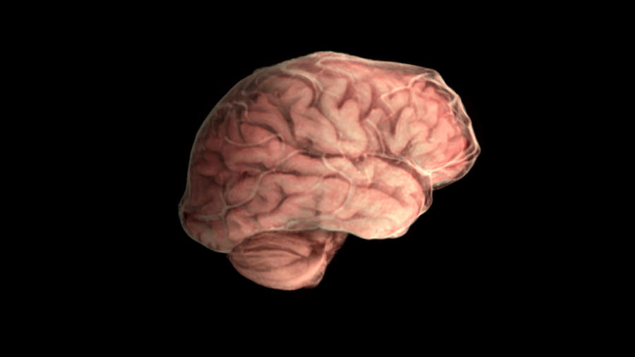 Brain With Alzheimers Disease, Lateral by Anatomical Travelogue