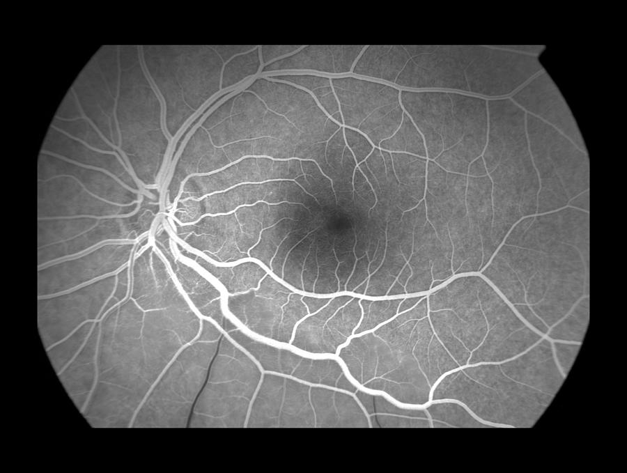 Branch Retinal Artery Occlusion, 4 Of 5 Photograph by Paul Whitten