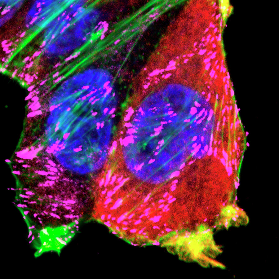 Breast Cancer Adhesions Photograph by Massey Cancer Center At Virginia Commonwealth University/national Cancer Institute/science Photo Library