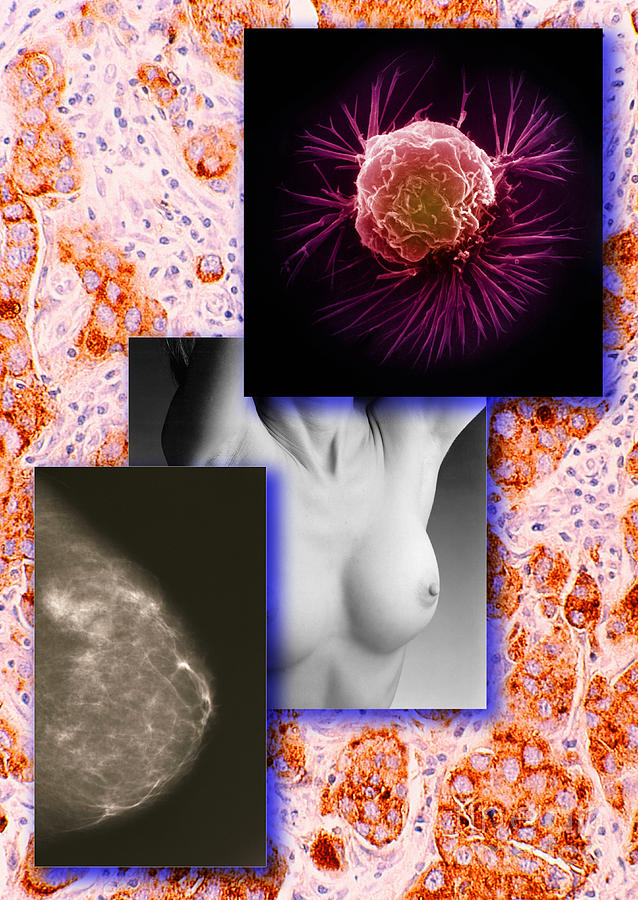 Pathology Photograph - Breast Cancer Montage by Scott Camazine