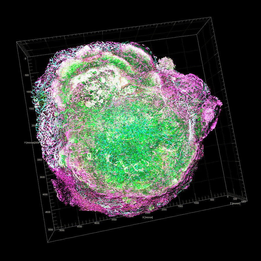 Tissue Photograph - Breast Cancer by University Of Chicago Comprehensive Cancer Center/national Cancer Institute/science Photo Library
