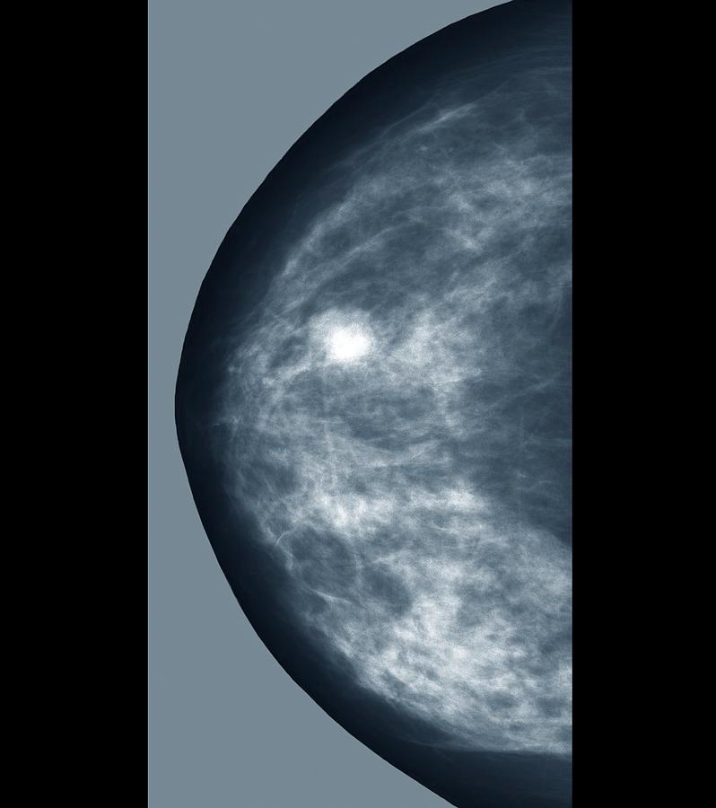 Abnormal Photograph - Breast Lump by Zephyr/science Photo Library