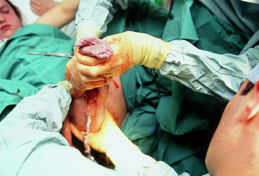 Breech Birth Photograph by Eddie Lawrence/science Photo Library