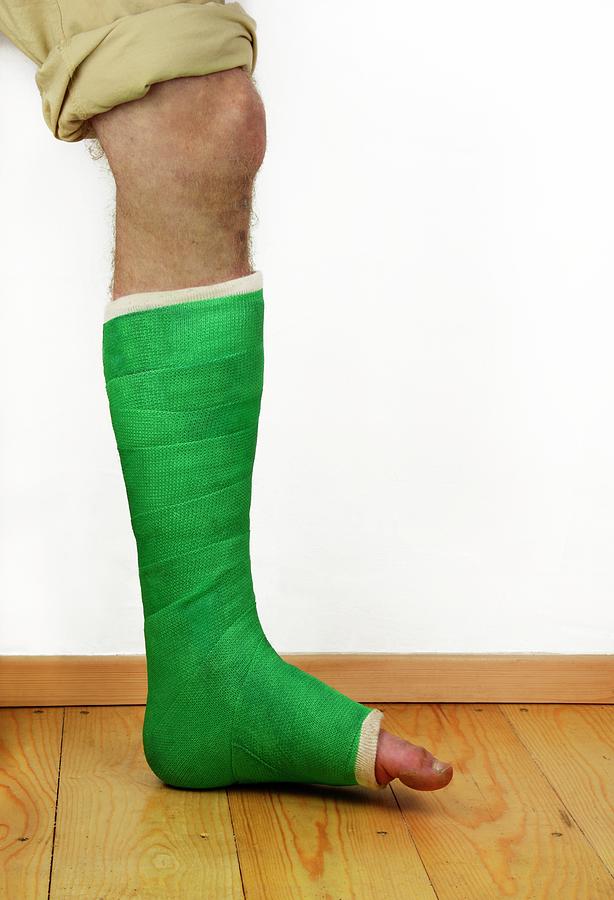 Broken Ankle Walking Cast