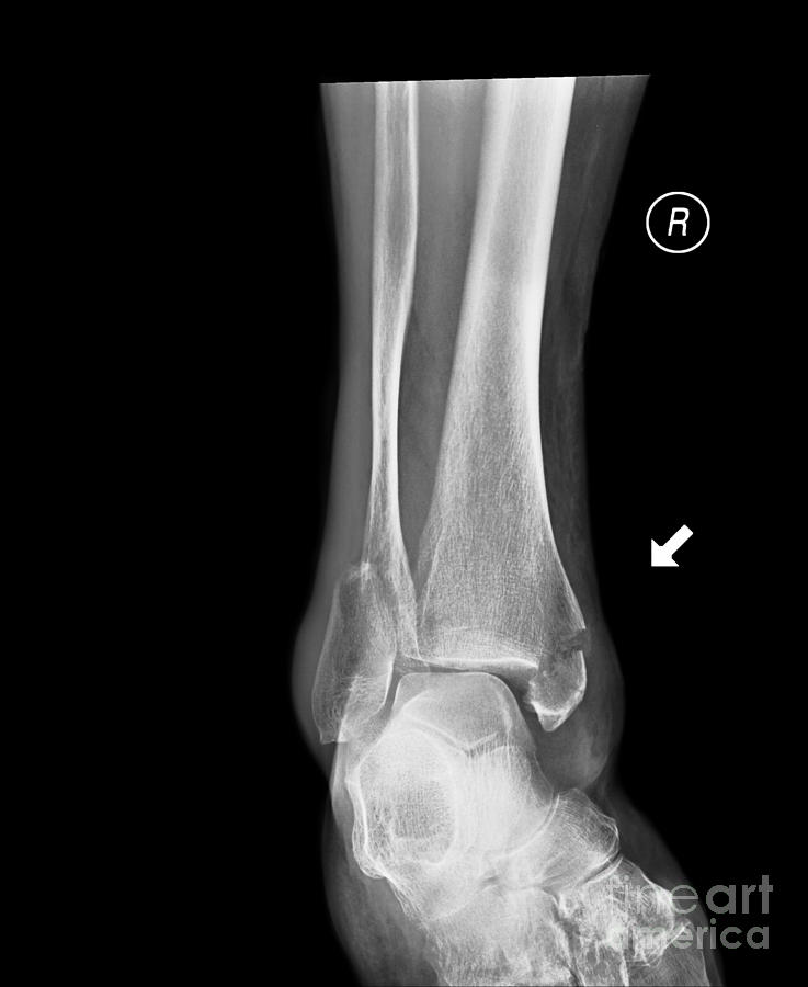Broken Ankle Images – Browse 469 Stock Photos, Vectors, and Video