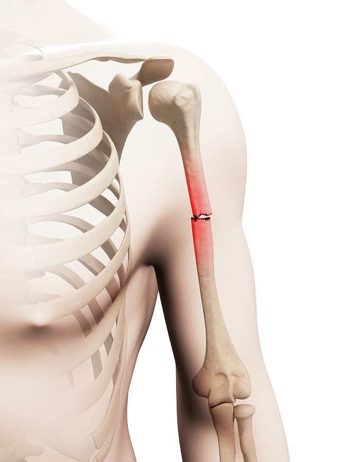 Break a bone. Перелом в/3 плечевой кости. Перелом средней трети плеча.