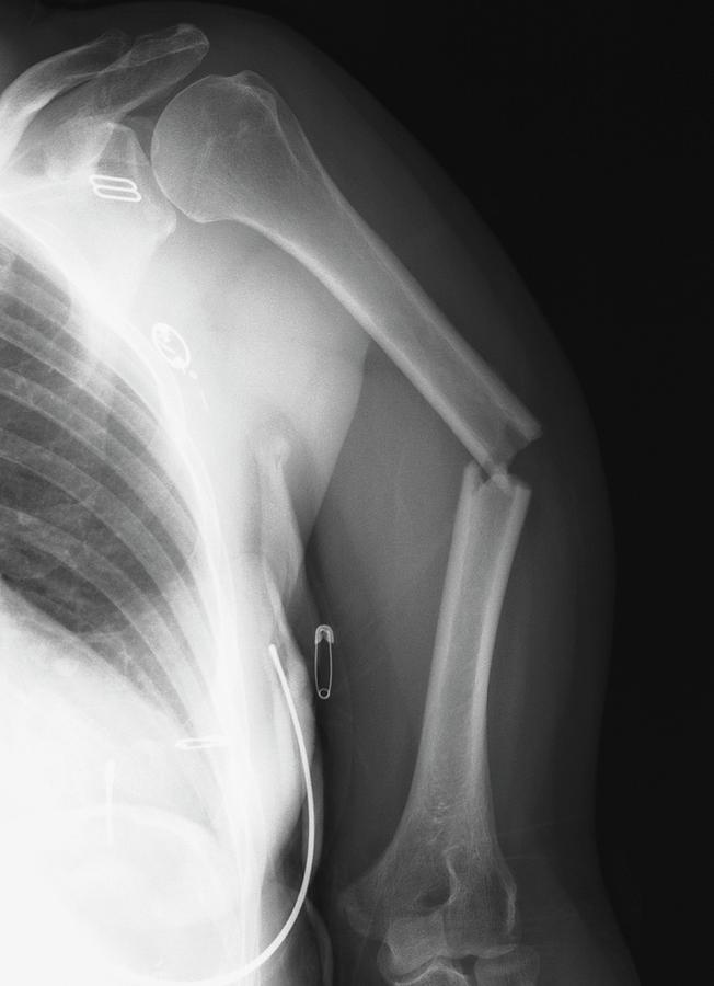 Broken Arm Bone Photograph by Zephyr/science Photo Library