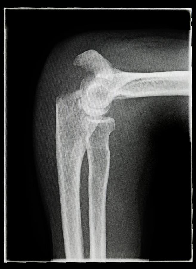 Broken Elbow Photograph by Antonia Reeve/science Photo Library