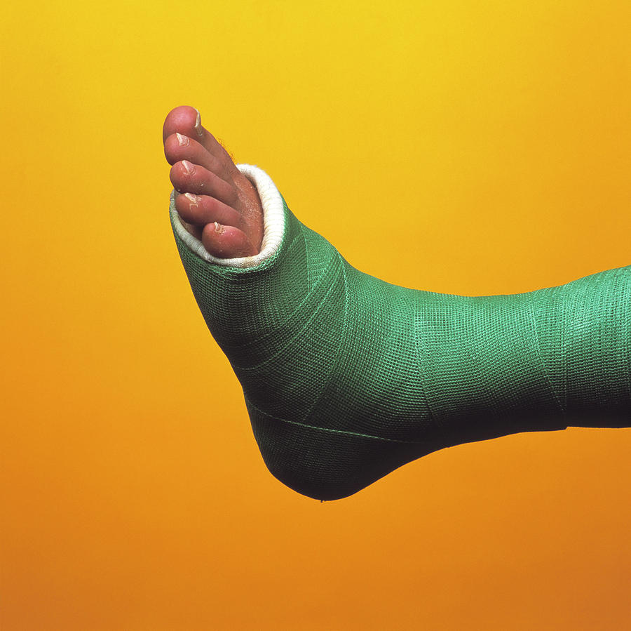 Broken Foot Photograph by Alex Bartel/science Photo Library