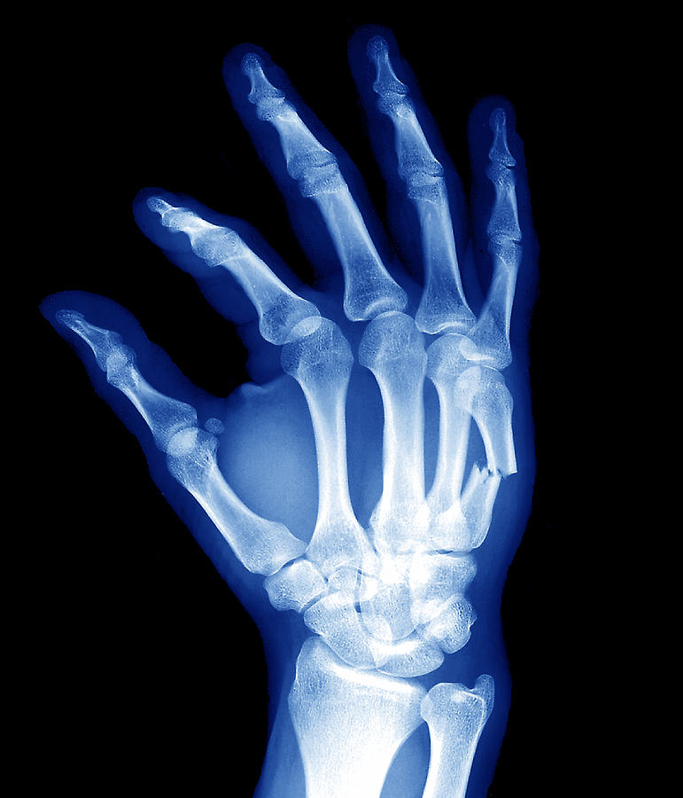 Broken Hand Bone Photograph by Zephyr/science Photo Library