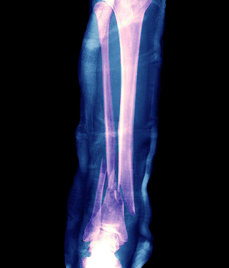 Broken Photograph - Broken Lower Leg Bones by Zephyr/science Photo Library