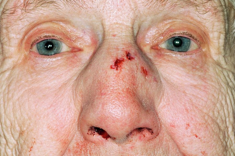 Broken Nose After A Fall Photograph By Dr P Marazzi Science Photo Library   Broken Nose After A Fall Dr P Marazziscience Photo Library 